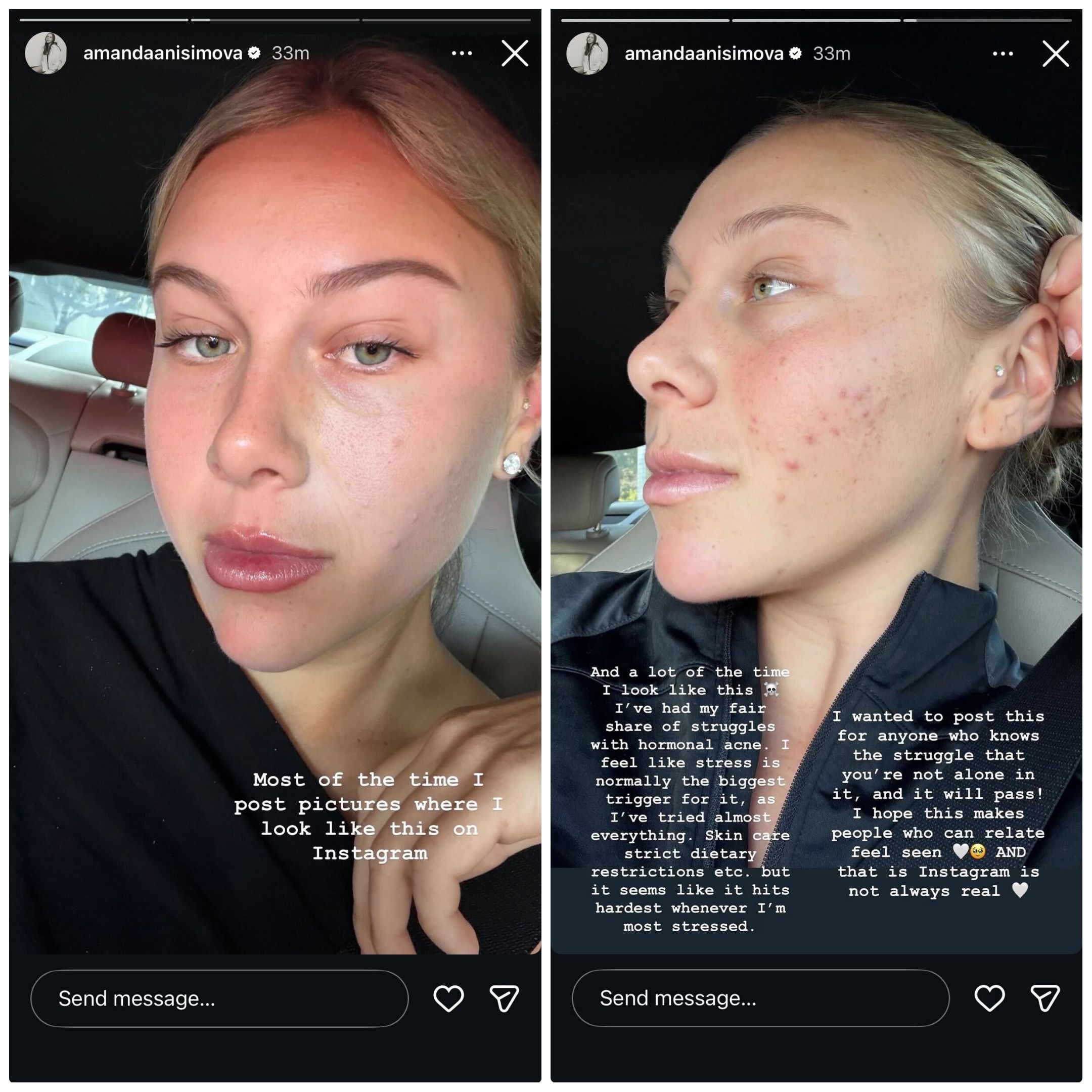Screen grab of Amanda Anisimova's Instagram story